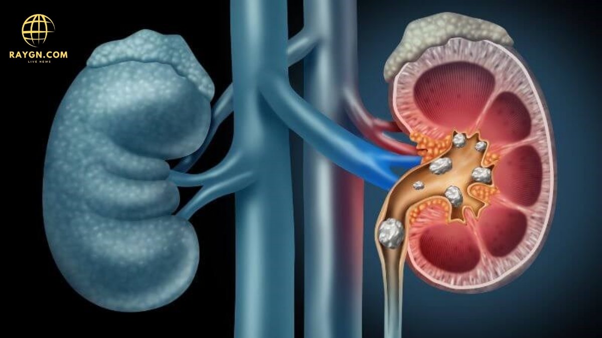 10 Warning Signs of Kidney Disease You Should Never Ignore: Early Detection Tips