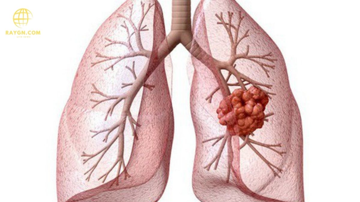 Finger Test for Lung Cancer: Early Detection and What You Need to Know