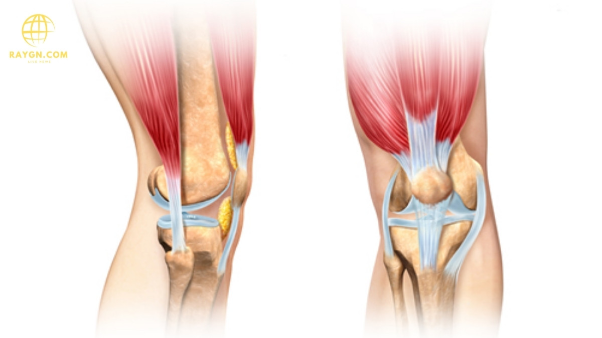 Knee Knock Treatment: Effective Solutions for Correcting Knock-Knees