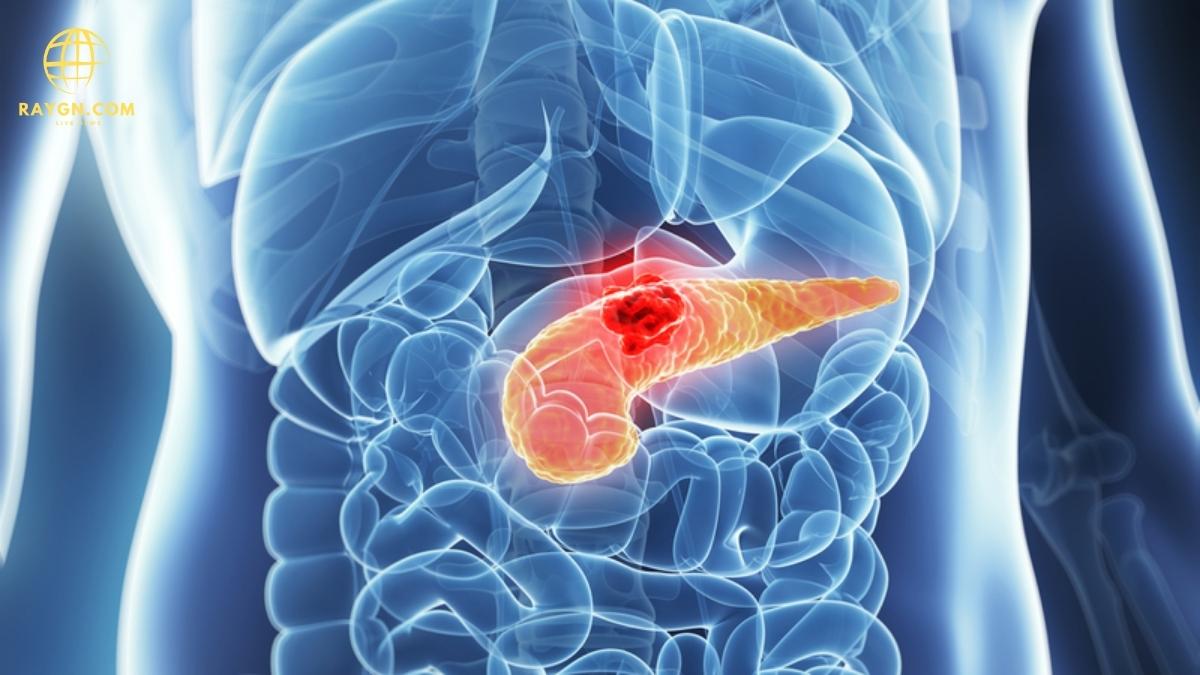 10 Warning Signs of Pancreatic Cancer You Should Never Ignore