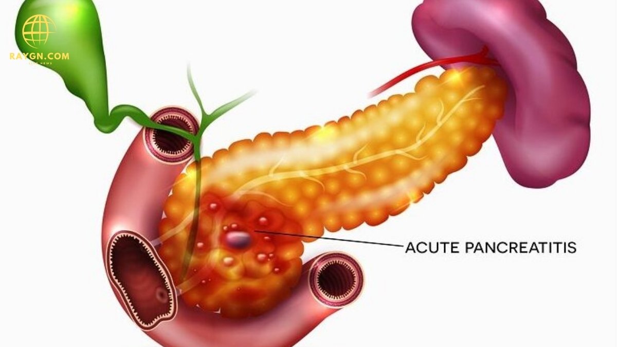 10 Warning Signs of Pancreatic Cancer You Should Never Ignore