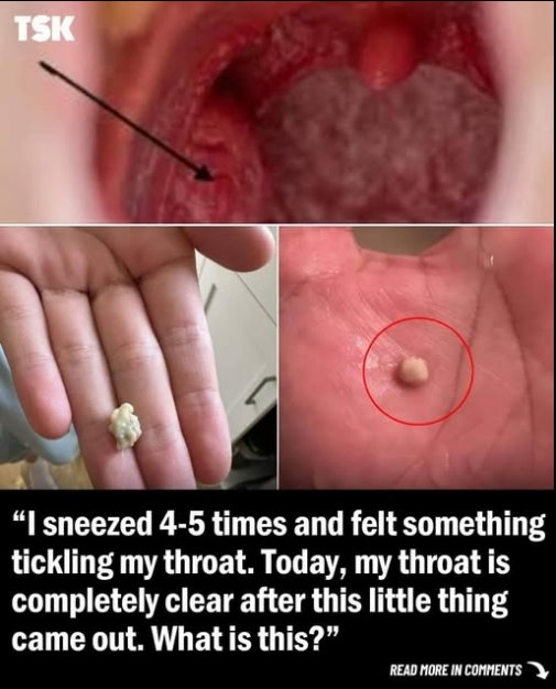 Here’s what you need to know about tonsil stones – the weird pimple-like growths in your throat