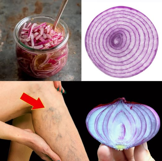 Incredible! Red Onion: The Ultimate Varicose Vein Solution! Eliminates Varicose Veins Effortlessly!