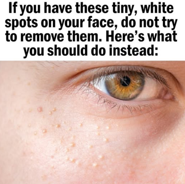 If You Have These Tiny, White Bumps on Your Face, Don’t Try to Remove Them!