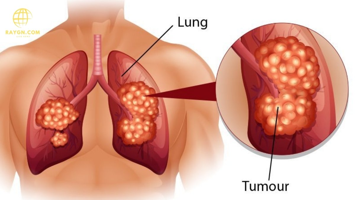 Finger Test for Lung Cancer: Early Detection and What You Need to Know